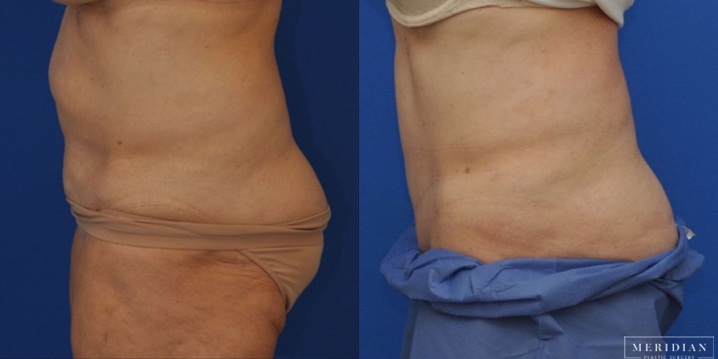 Tummy Tuck - Thumbnail 2