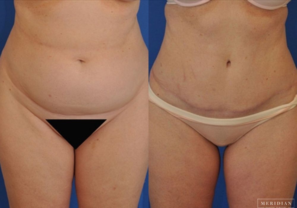 Before and after procedure result