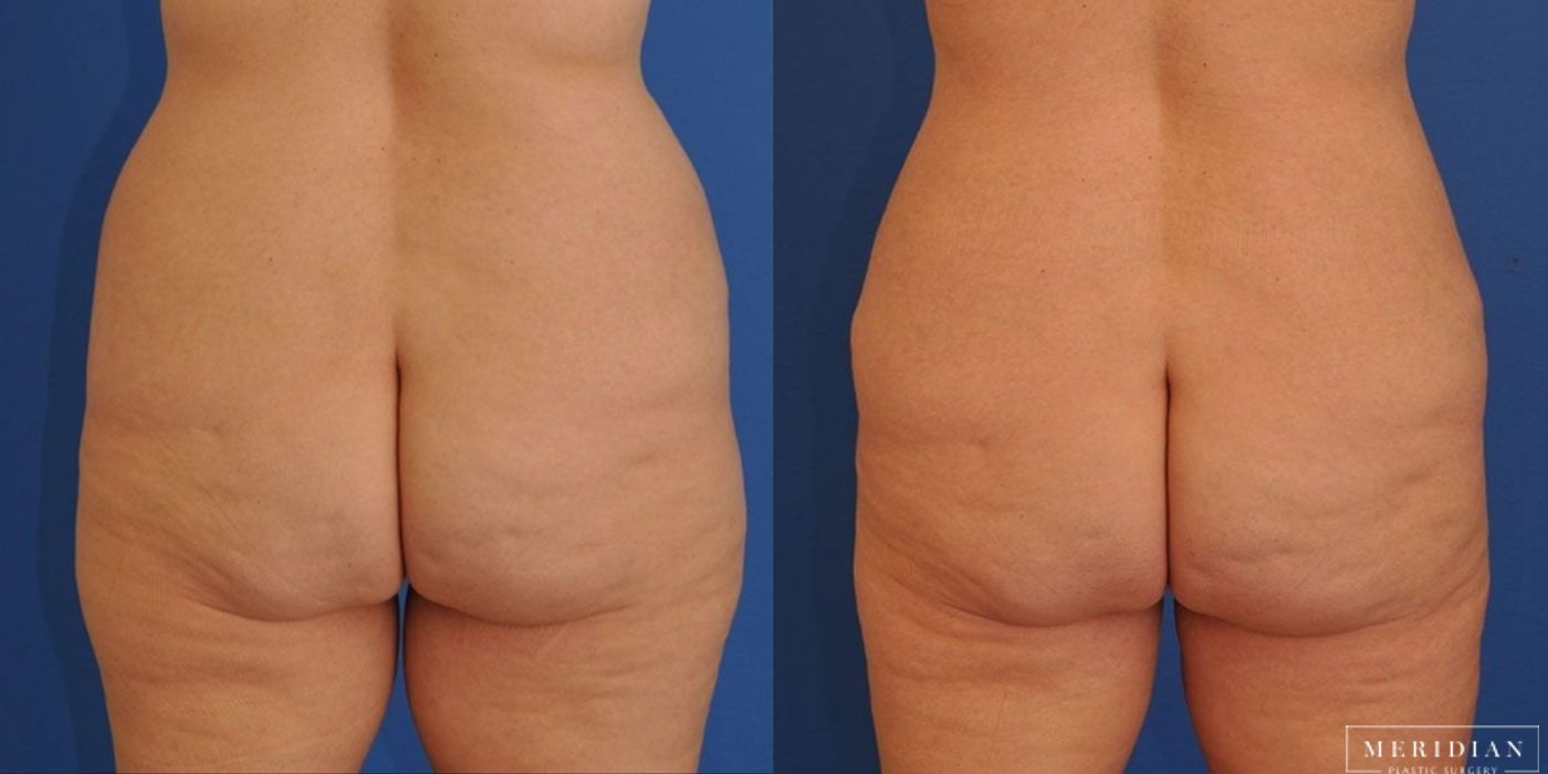 Tummy Tuck - Thumbnail 3