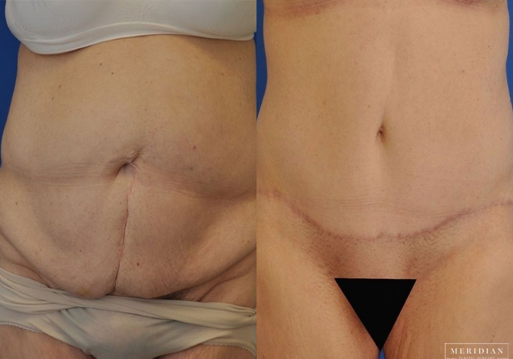 Tummy Tuck - Case 8004