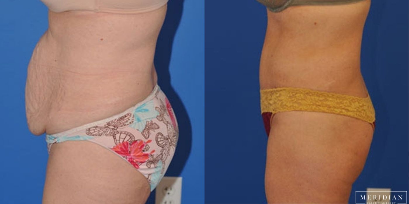 Tummy Tuck - Thumbnail 2