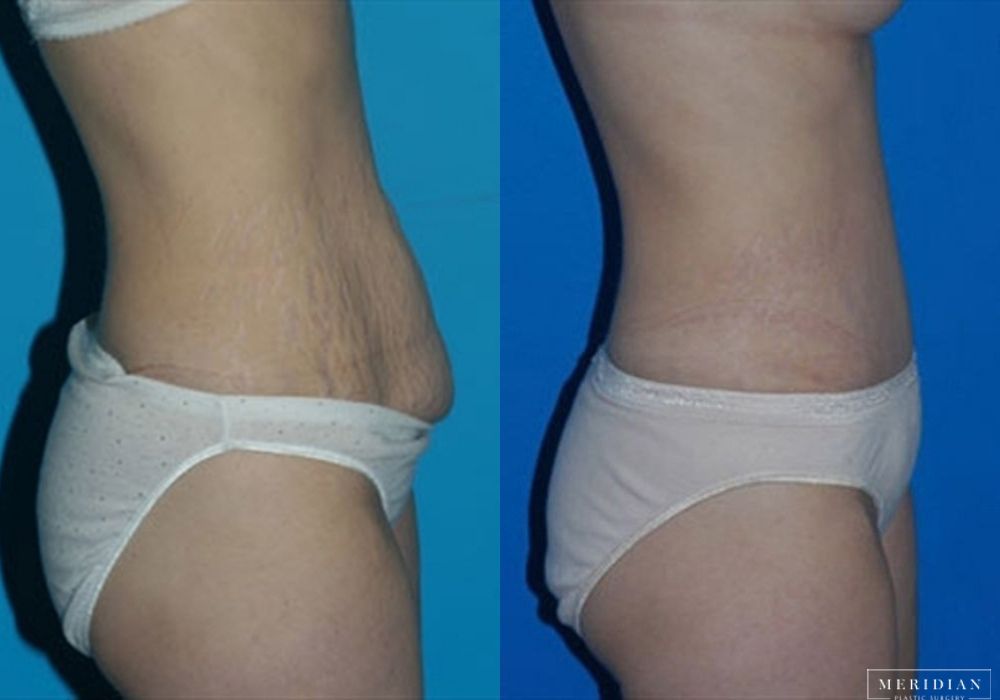 Tummy Tuck - Thumbnail 2