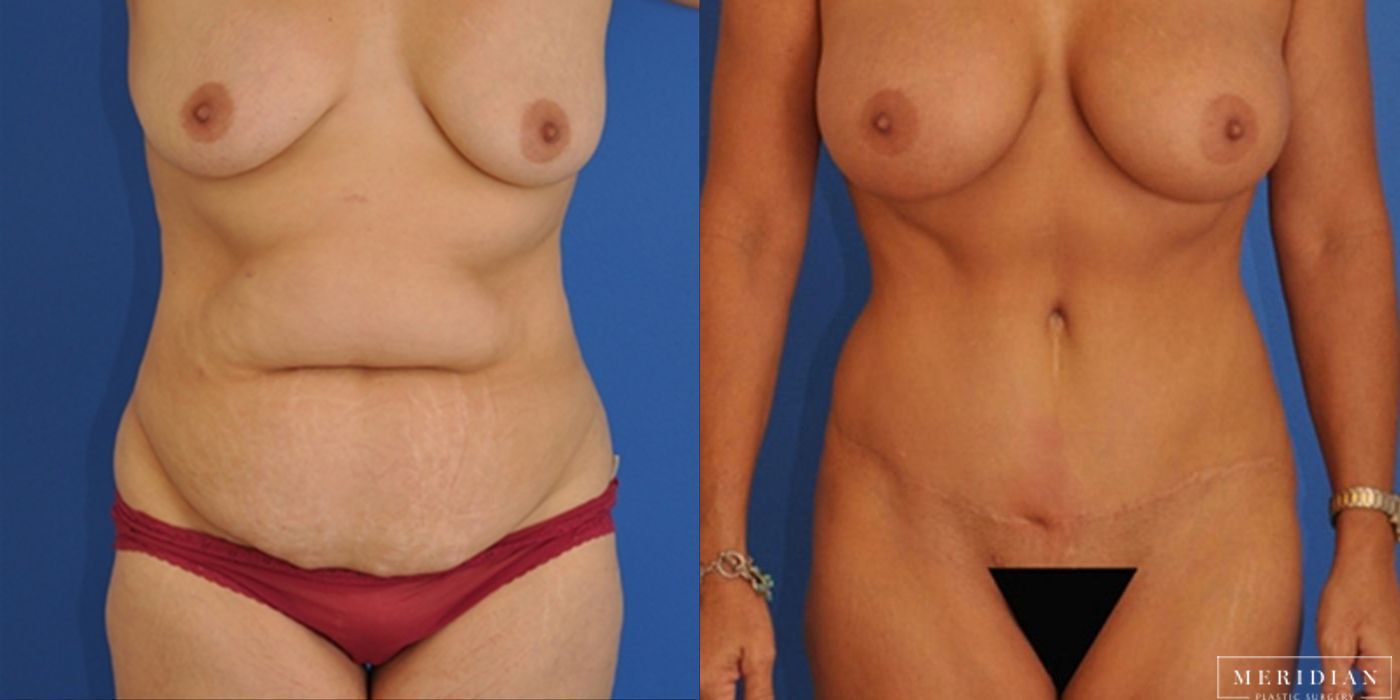 Tummy Tuck - Case 8471