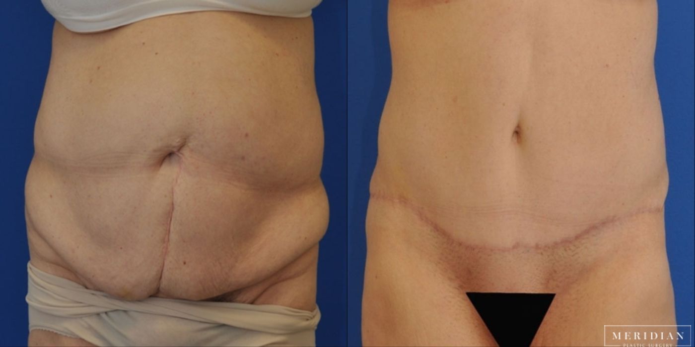 Tummy Tuck - Case 8487
