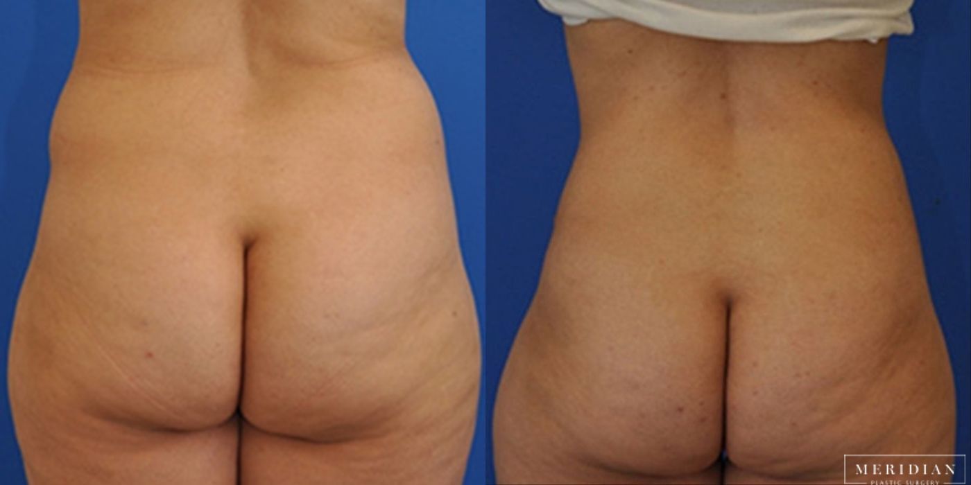 Tummy Tuck - Thumbnail 2