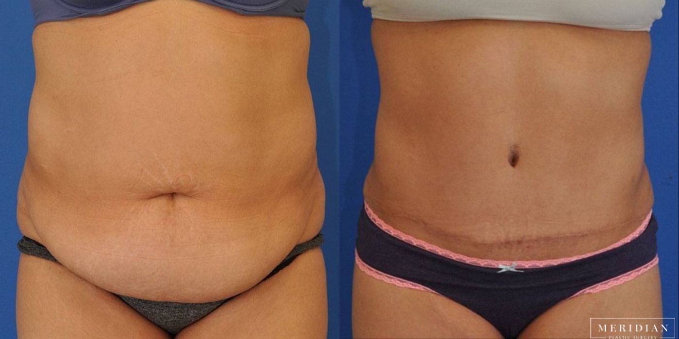 Tummy Tuck - Case 8488