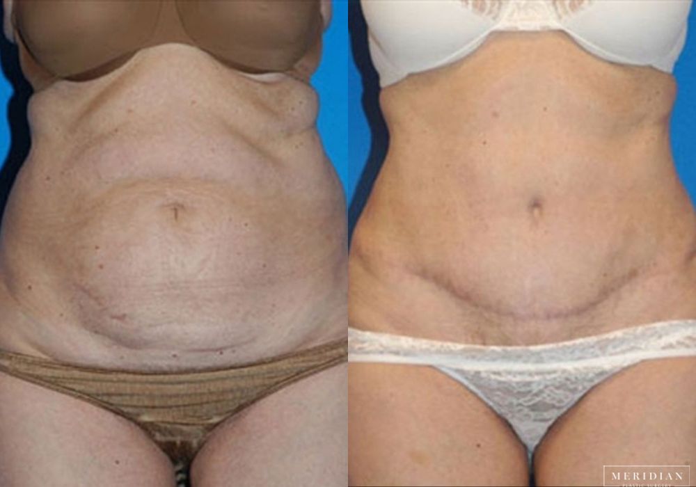 Before and after procedure result