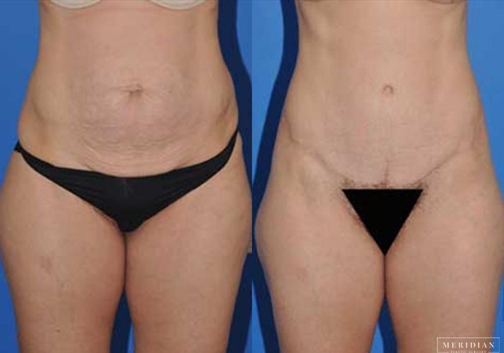 Before and after procedure result