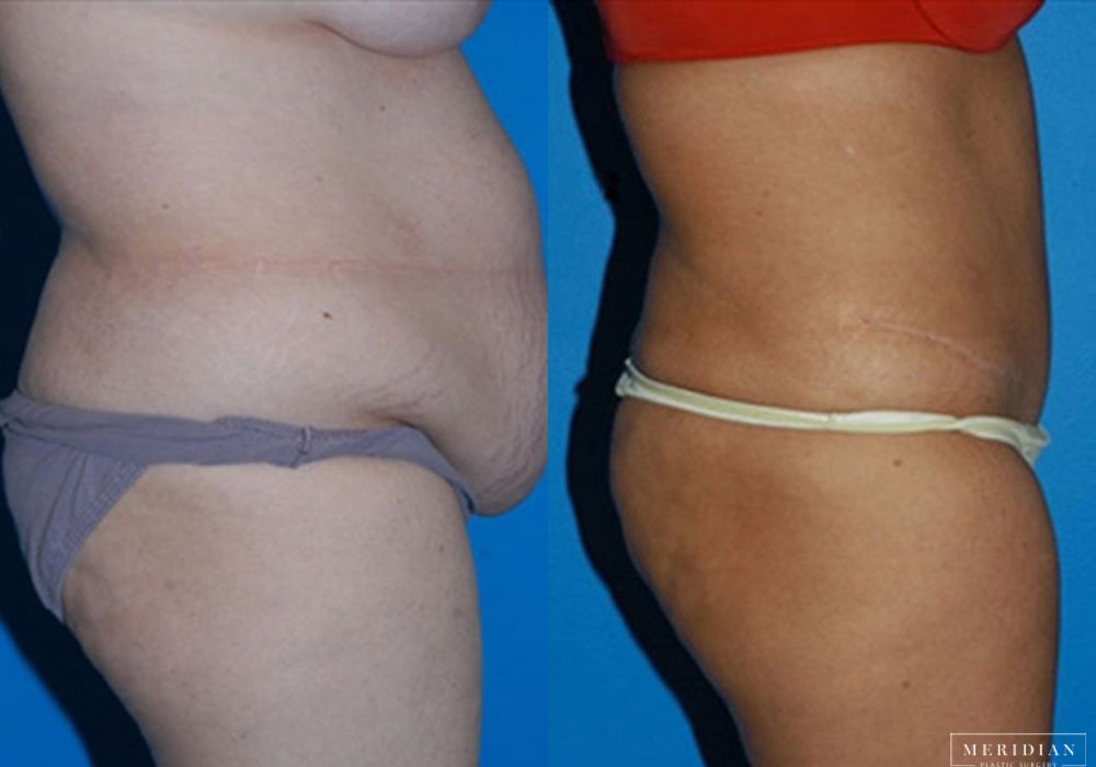 Tummy Tuck - Thumbnail 2