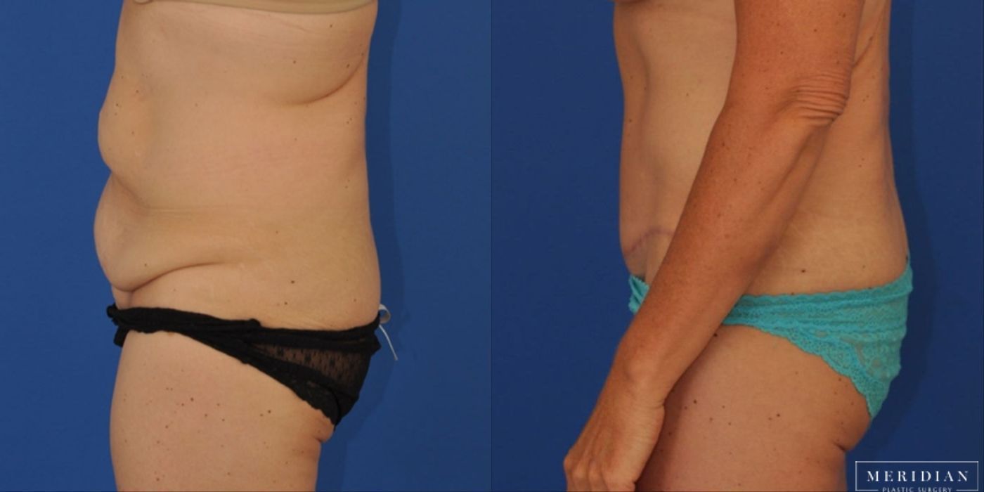 Tummy Tuck - Thumbnail 2