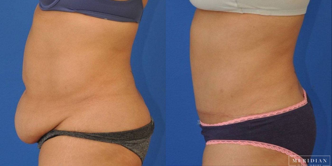 Tummy Tuck - Thumbnail 3