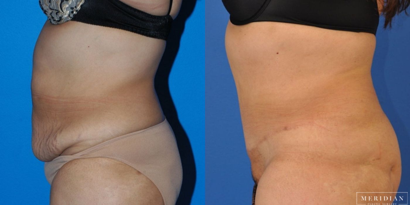 Tummy Tuck - Thumbnail 2