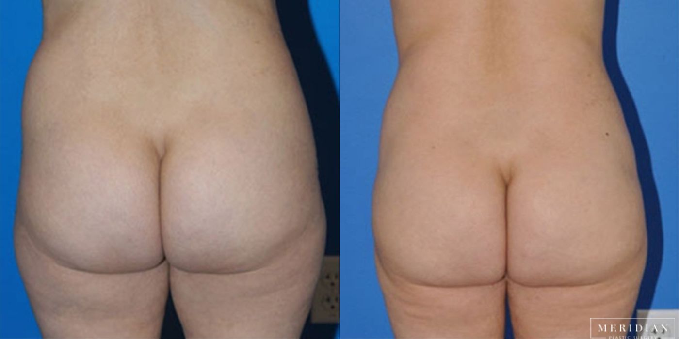 Tummy Tuck - Case 8480