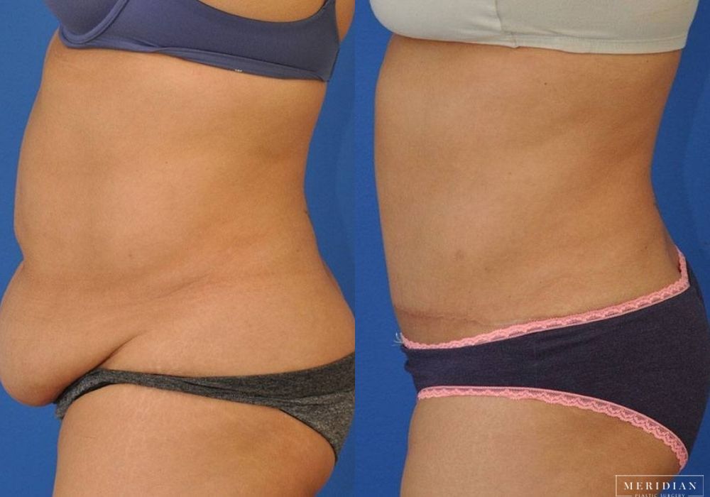 Tummy Tuck - Thumbnail 2