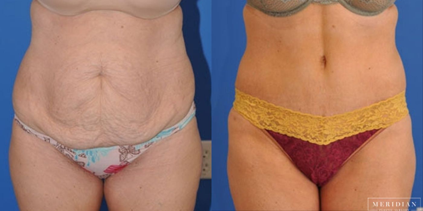 Tummy Tuck - Case 8472