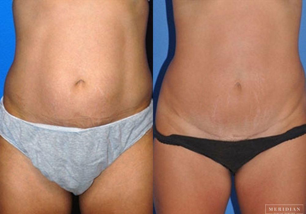 Before and after procedure result