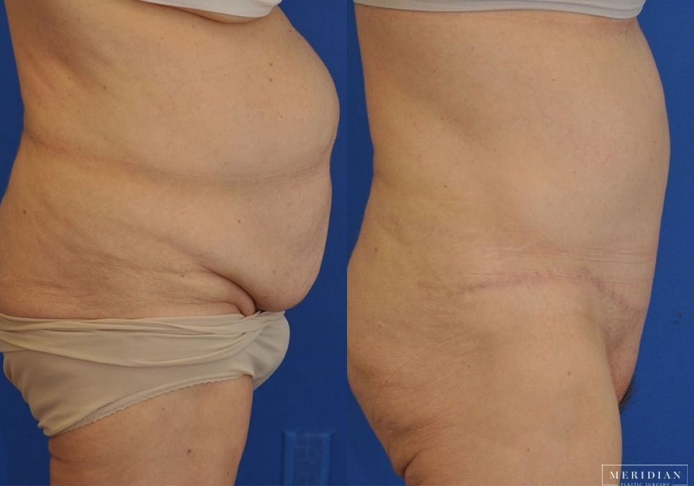 Tummy Tuck - Thumbnail 2