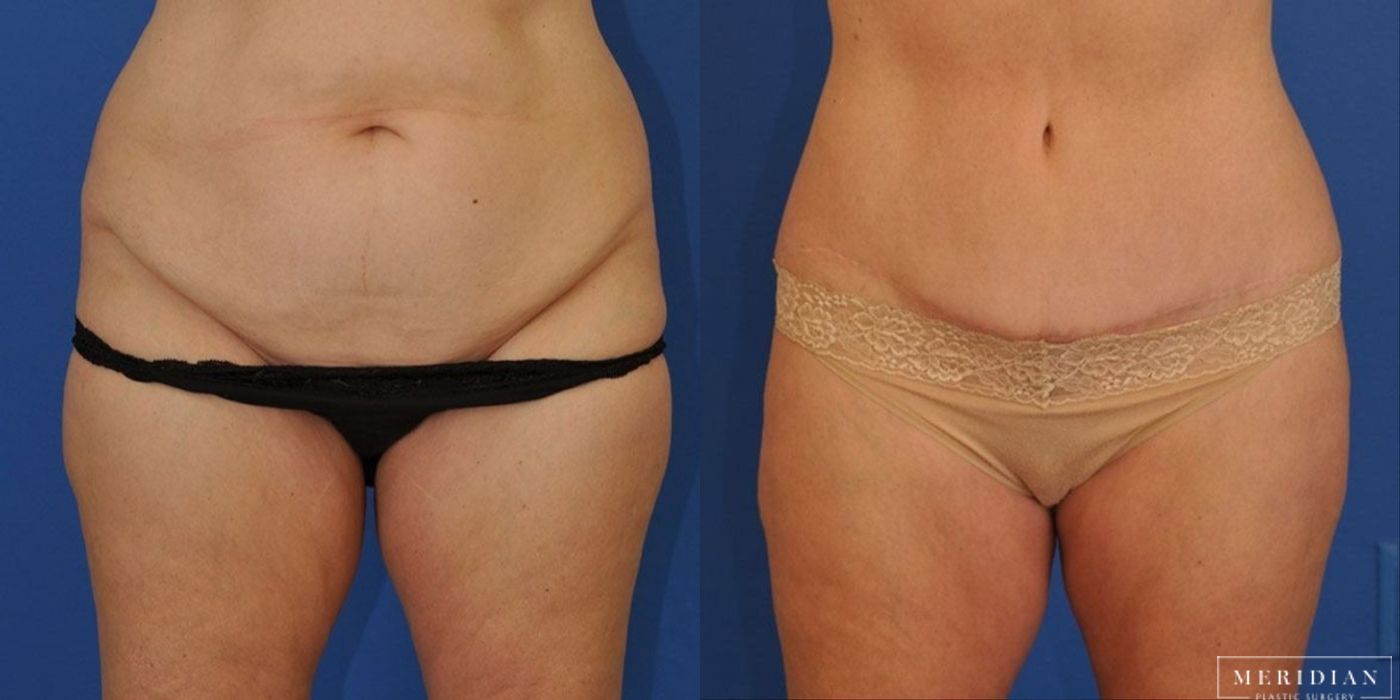 Tummy Tuck - Case 8489