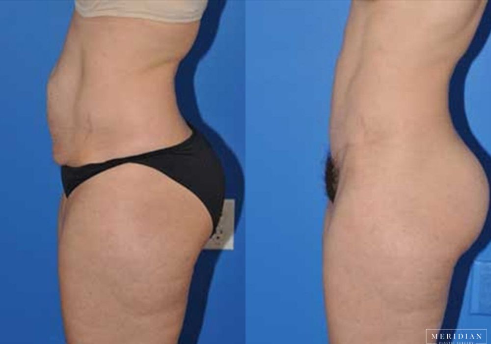 Tummy Tuck - Thumbnail 2