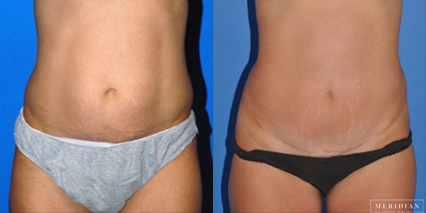 Tummy Tuck - Case 8476