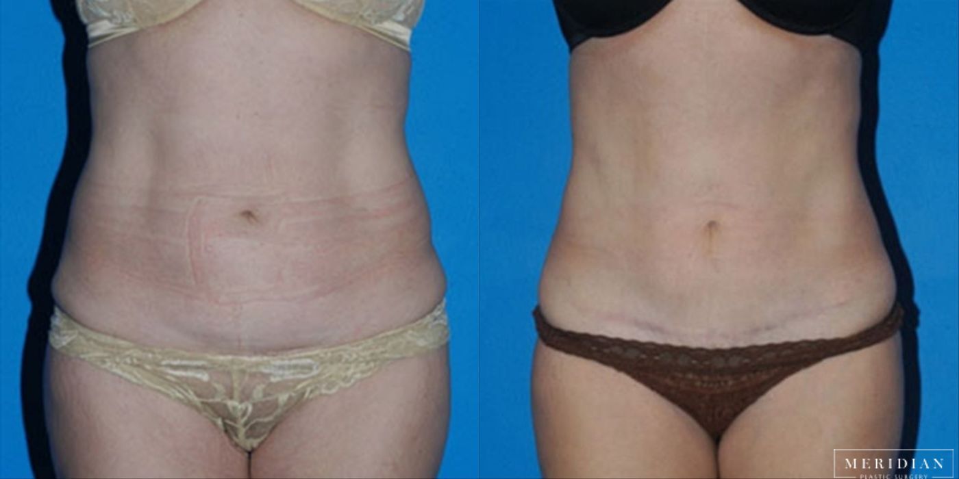 Tummy Tuck - Case 8479