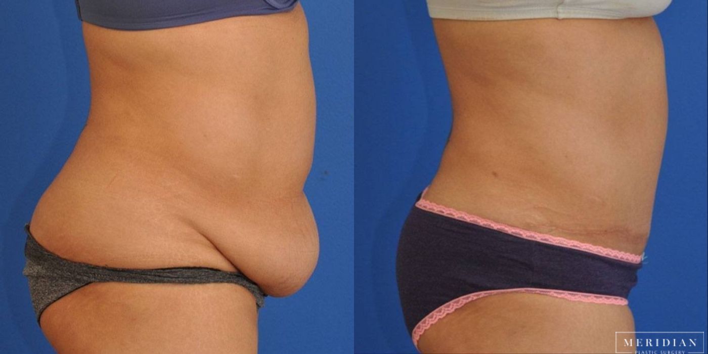 Tummy Tuck - Thumbnail 2