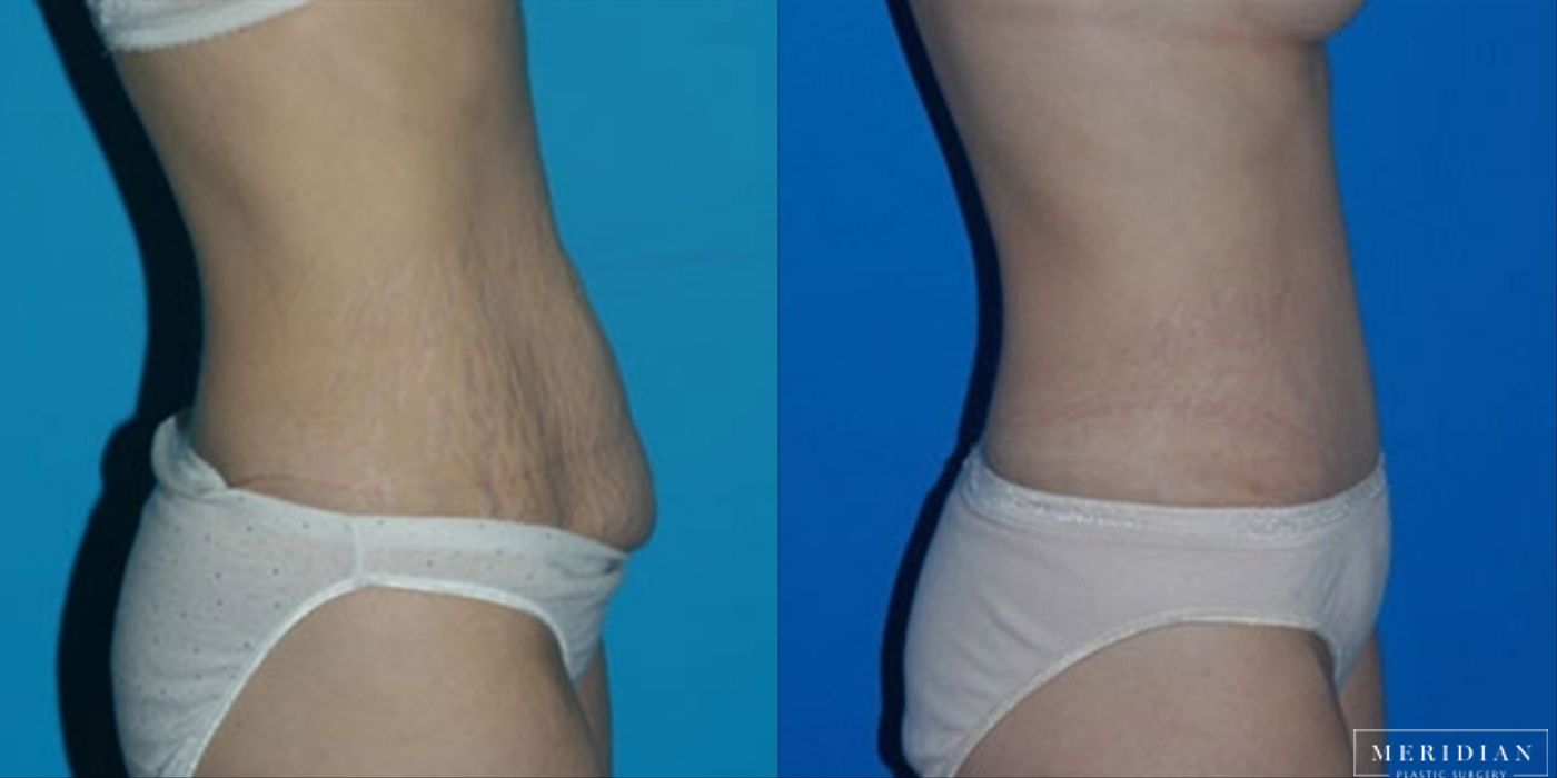 Tummy Tuck - Thumbnail 2