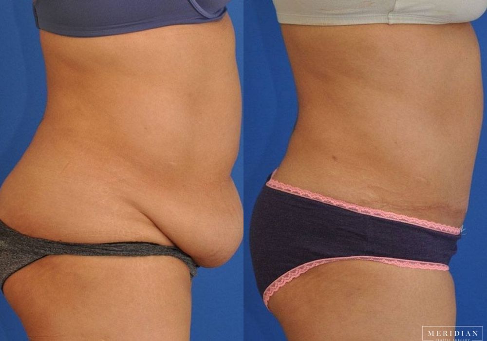 Tummy Tuck - Thumbnail 3