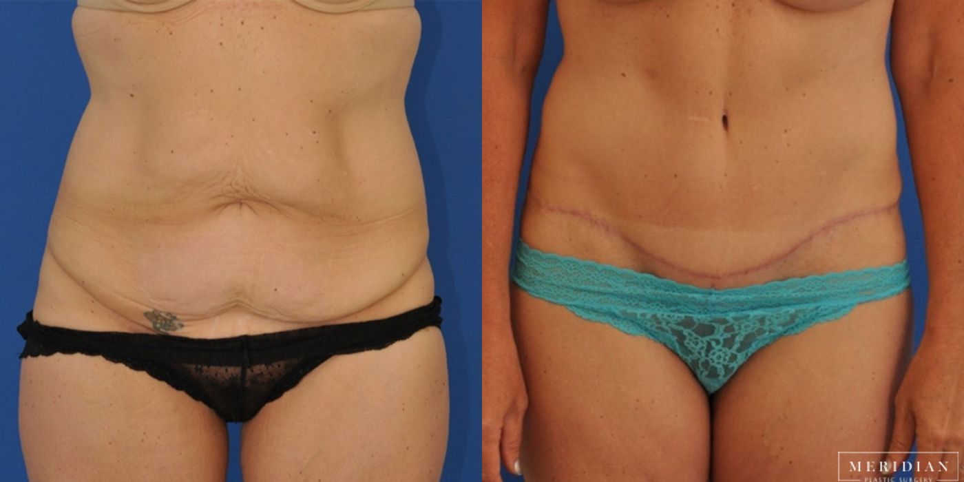 Tummy Tuck - Case 8486
