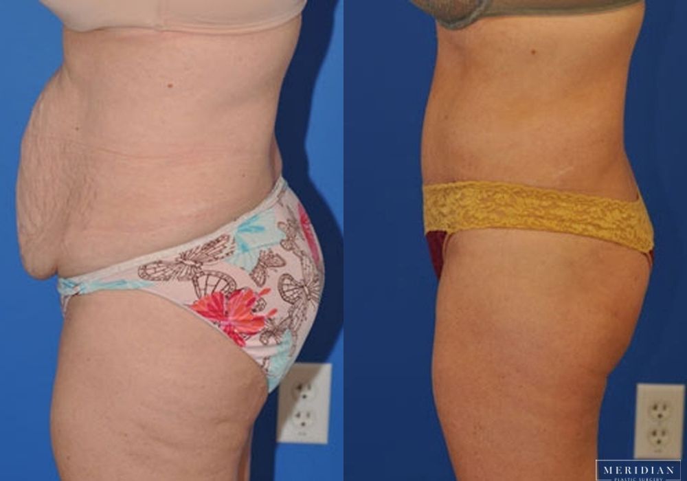 Tummy Tuck - Thumbnail 2