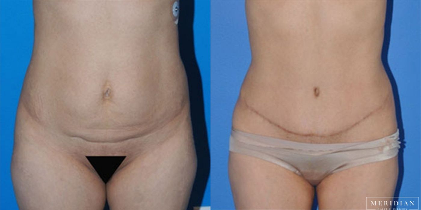 Tummy Tuck - Thumbnail 2