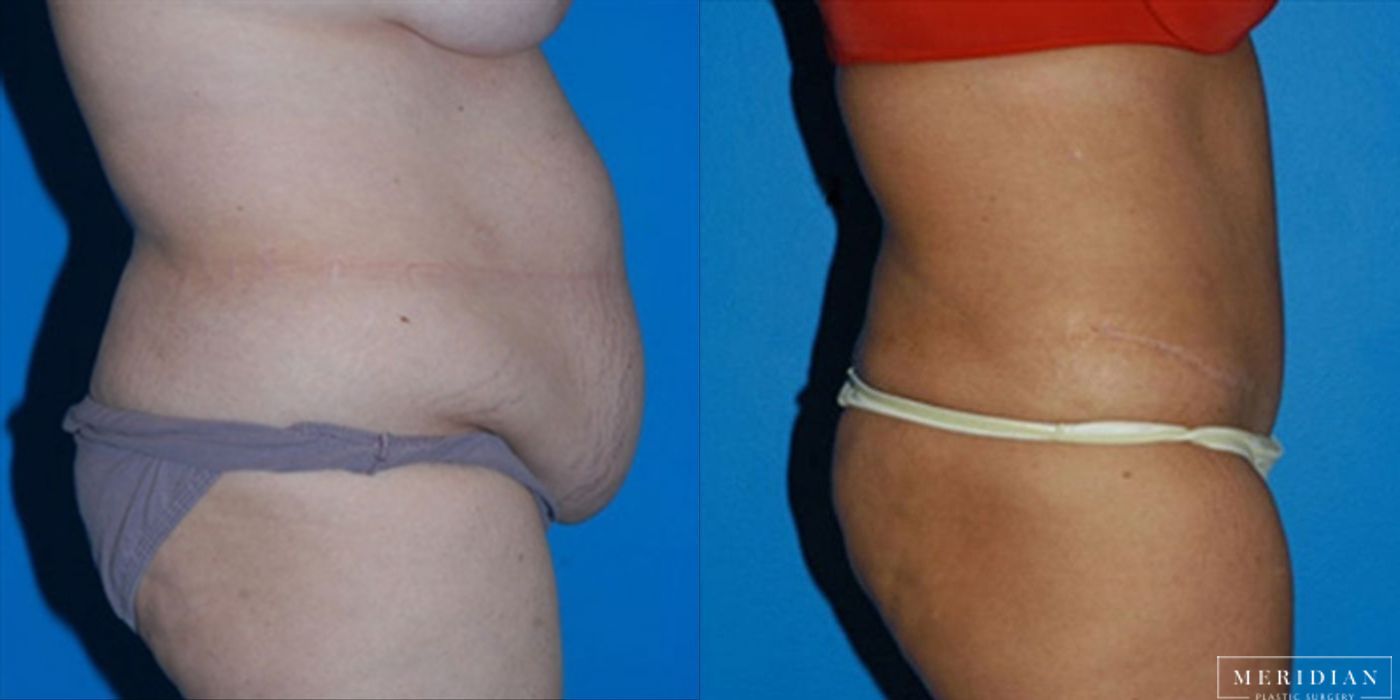 Tummy Tuck - Thumbnail 2