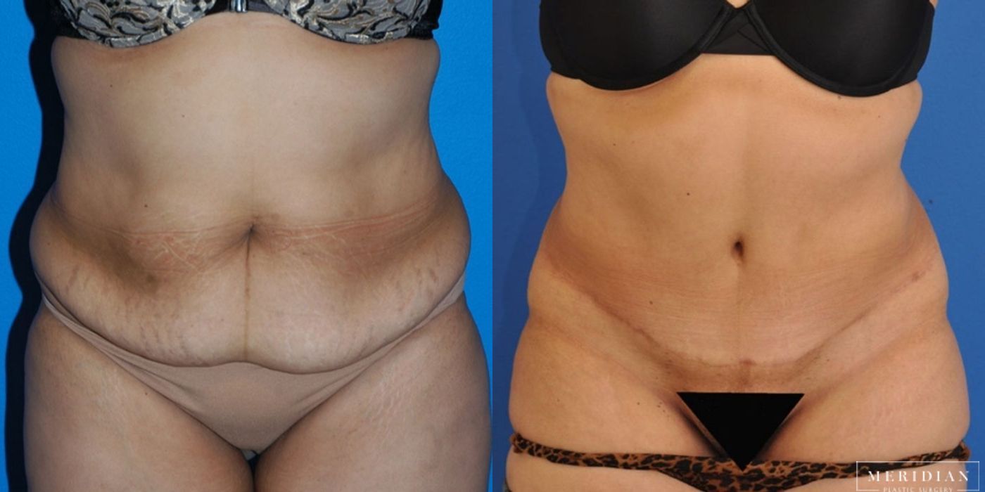 Tummy Tuck - Case 8484