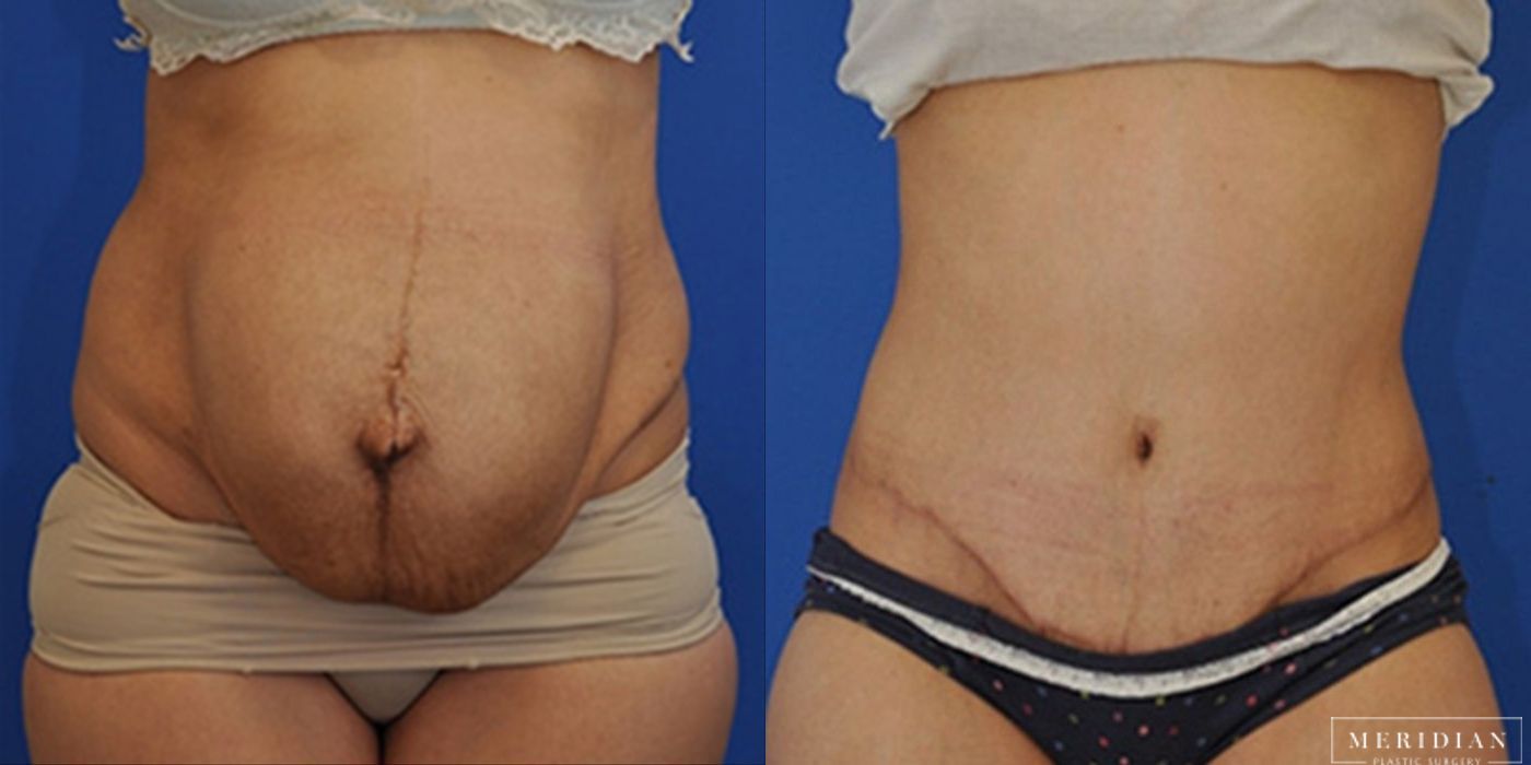 Tummy Tuck - Case 8475