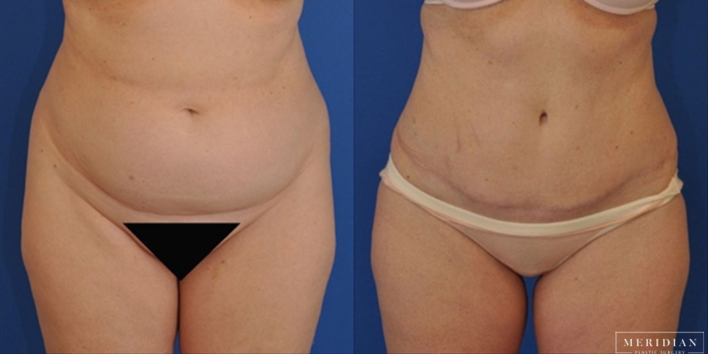 Tummy Tuck - Case 8477