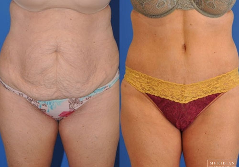 Before and after procedure result
