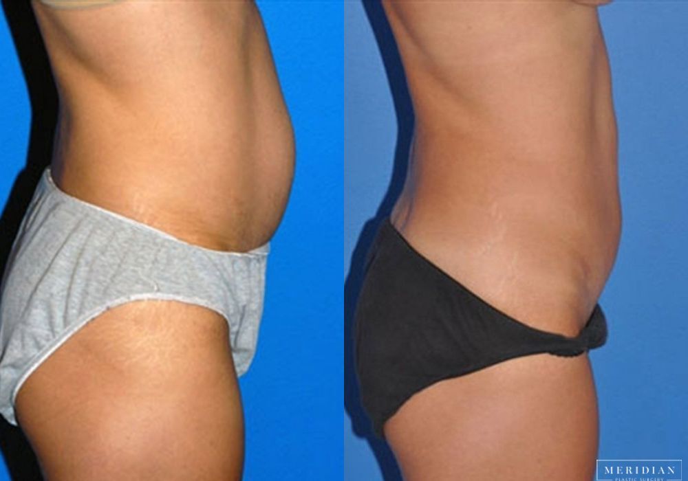 Tummy Tuck - Thumbnail 2