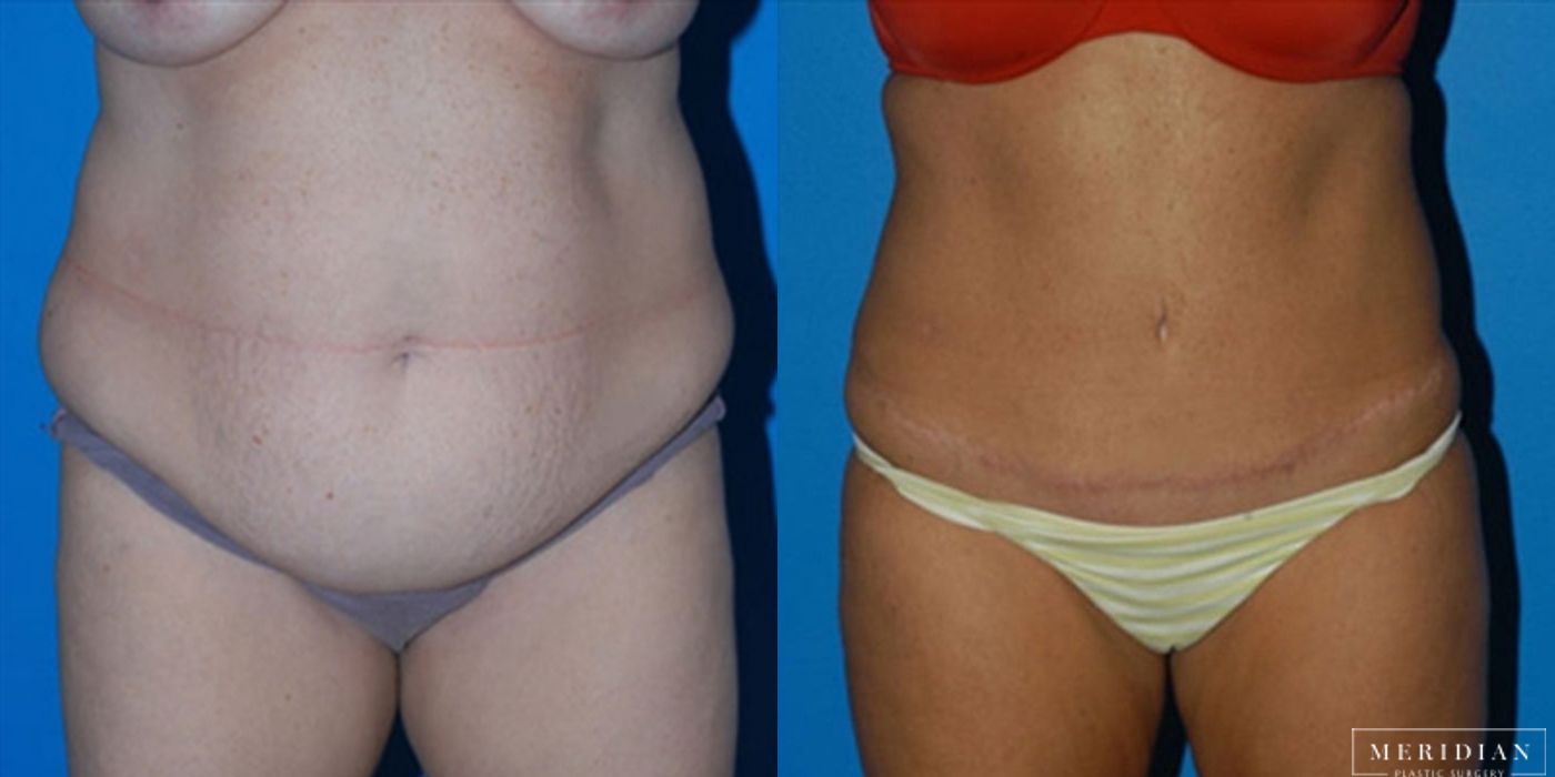 Tummy Tuck - Case 8481