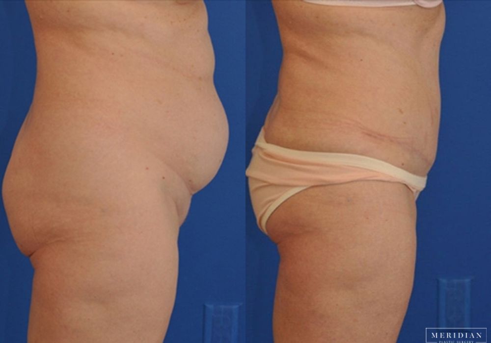 Tummy Tuck - Thumbnail 2