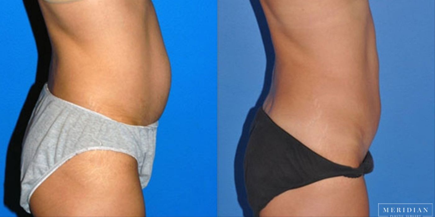 Tummy Tuck - Thumbnail 2