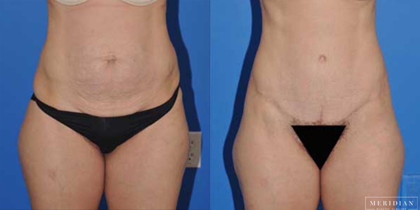 Tummy Tuck - Case 8473