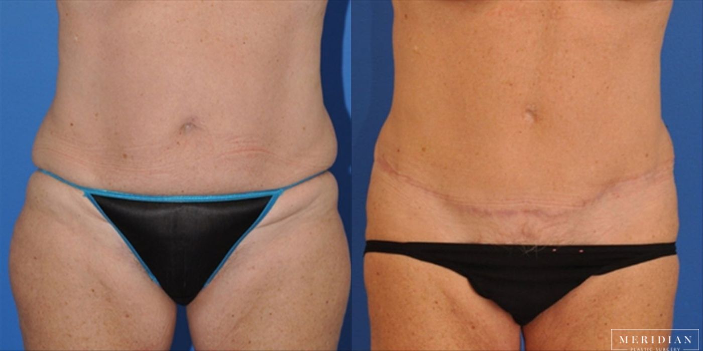 Tummy Tuck - Case 8483
