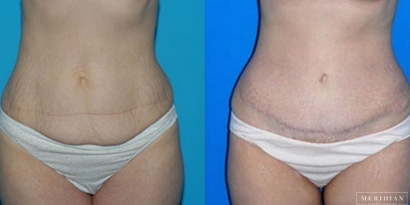 Tummy Tuck - Case 8482