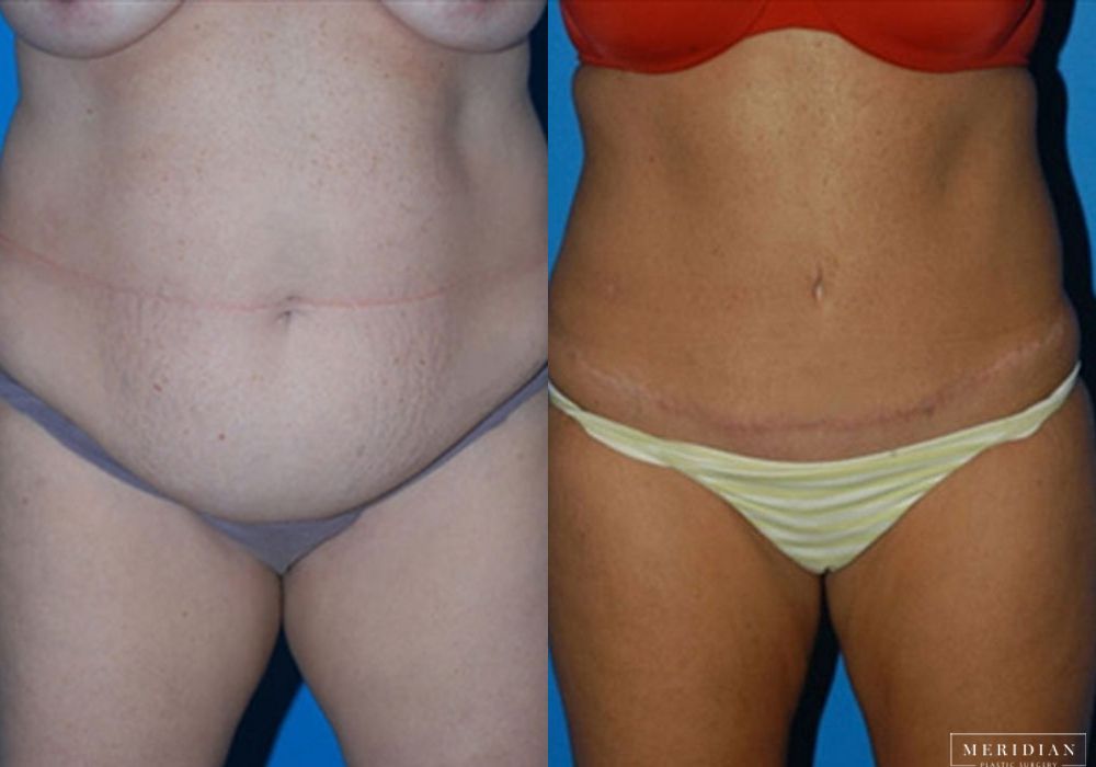 Tummy Tuck - Case 7793