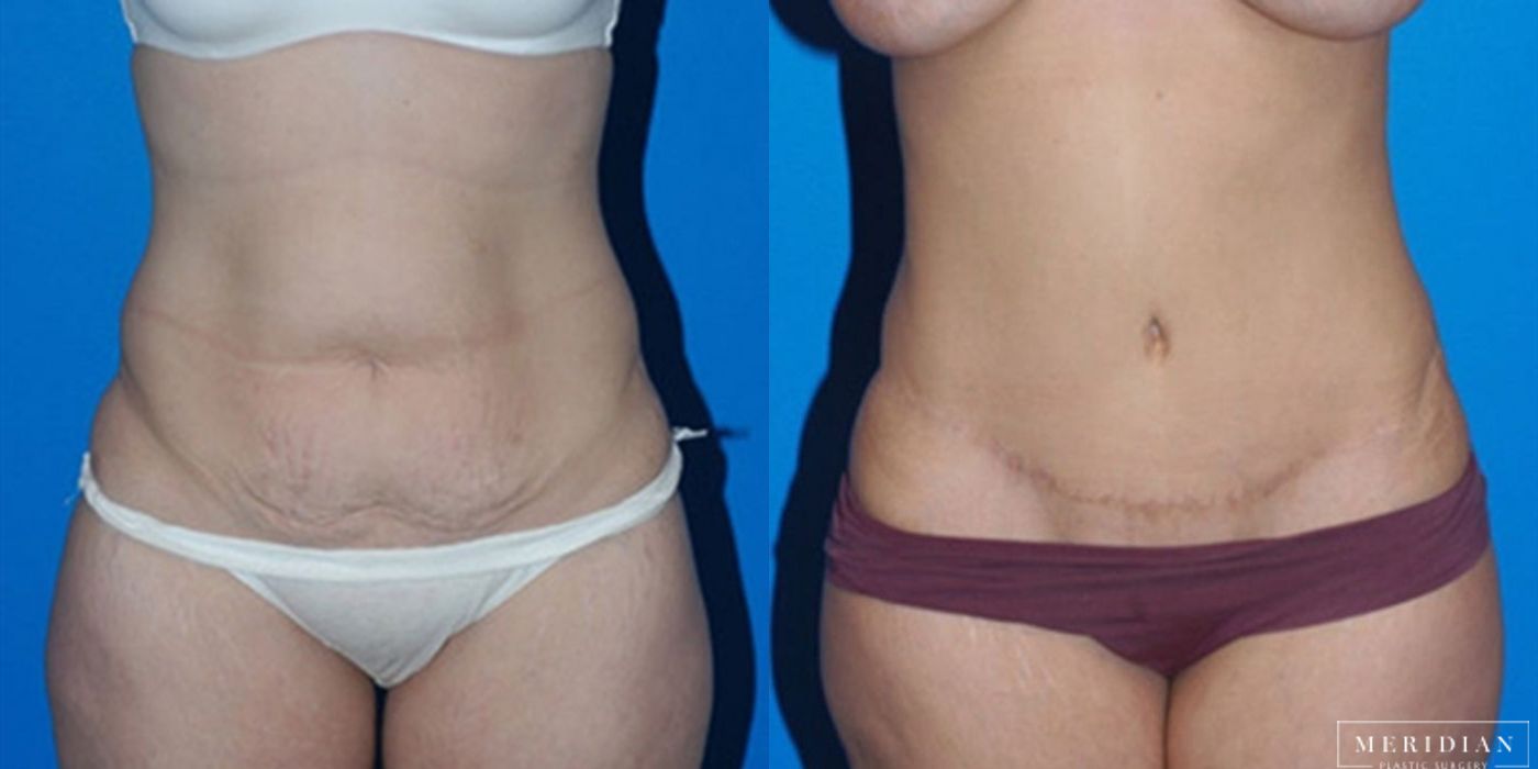 Tummy Tuck - Case 8474