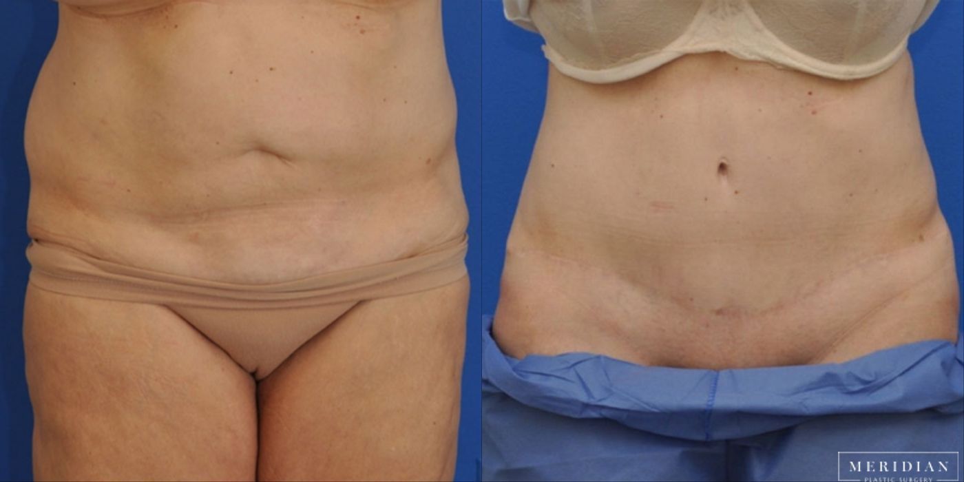 Tummy Tuck - Case 8485