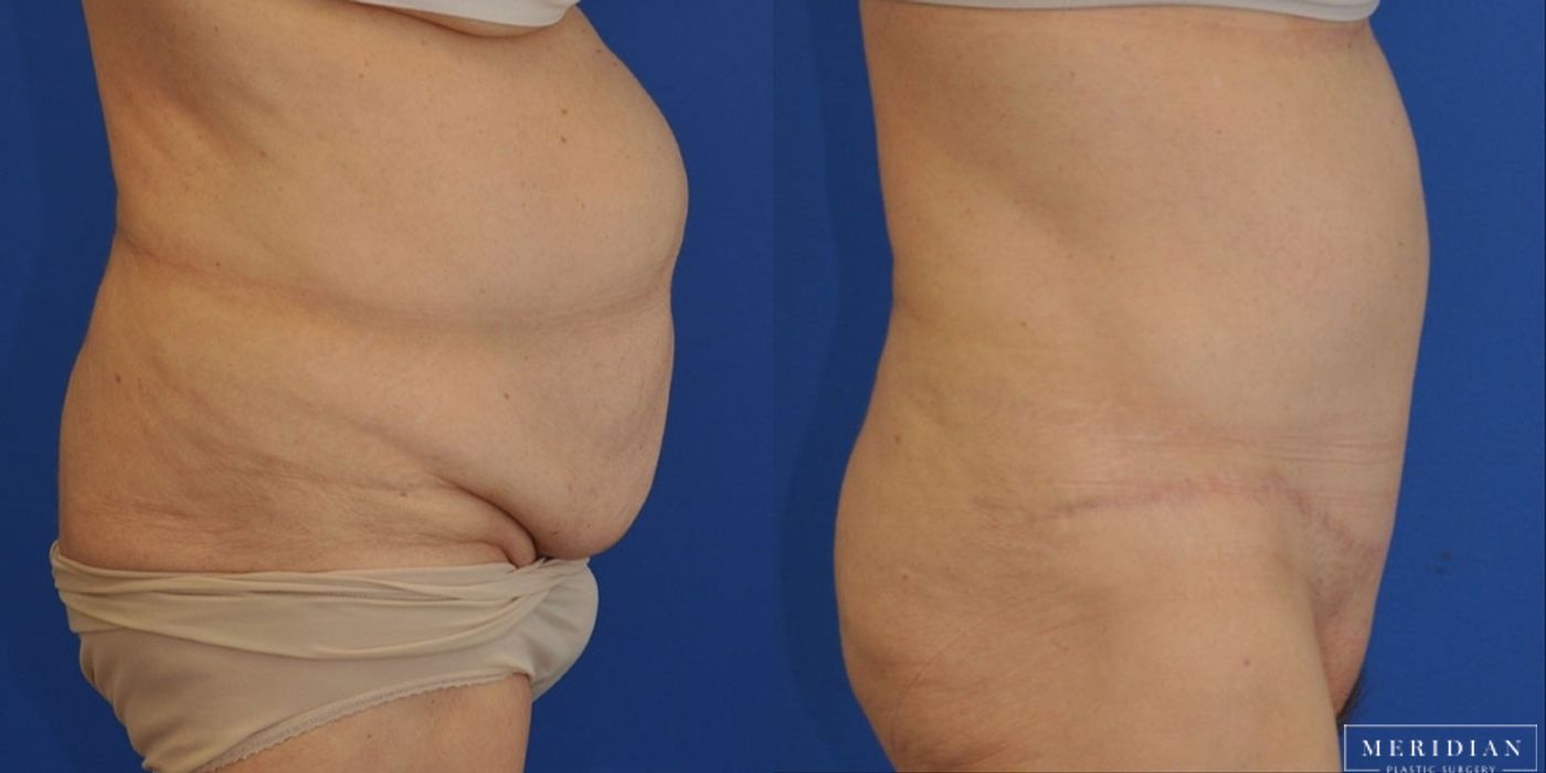 Tummy Tuck - Thumbnail 2