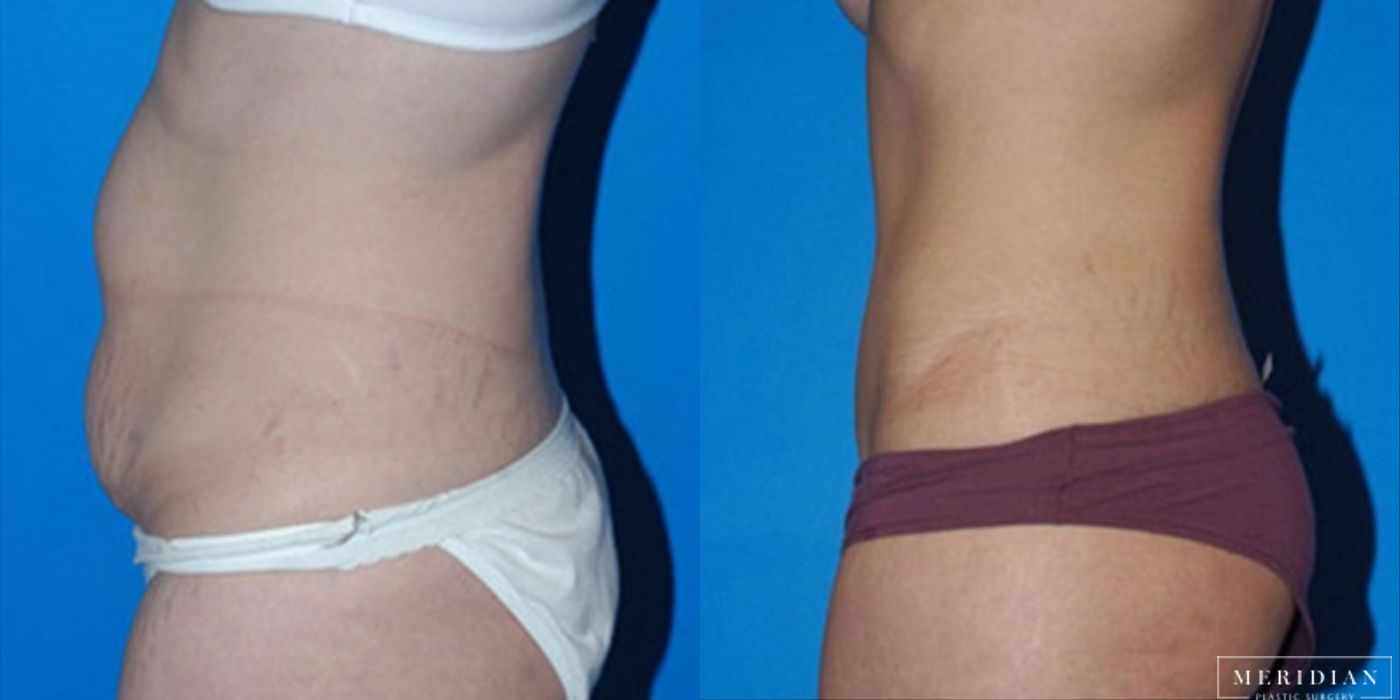 Tummy Tuck - Thumbnail 2