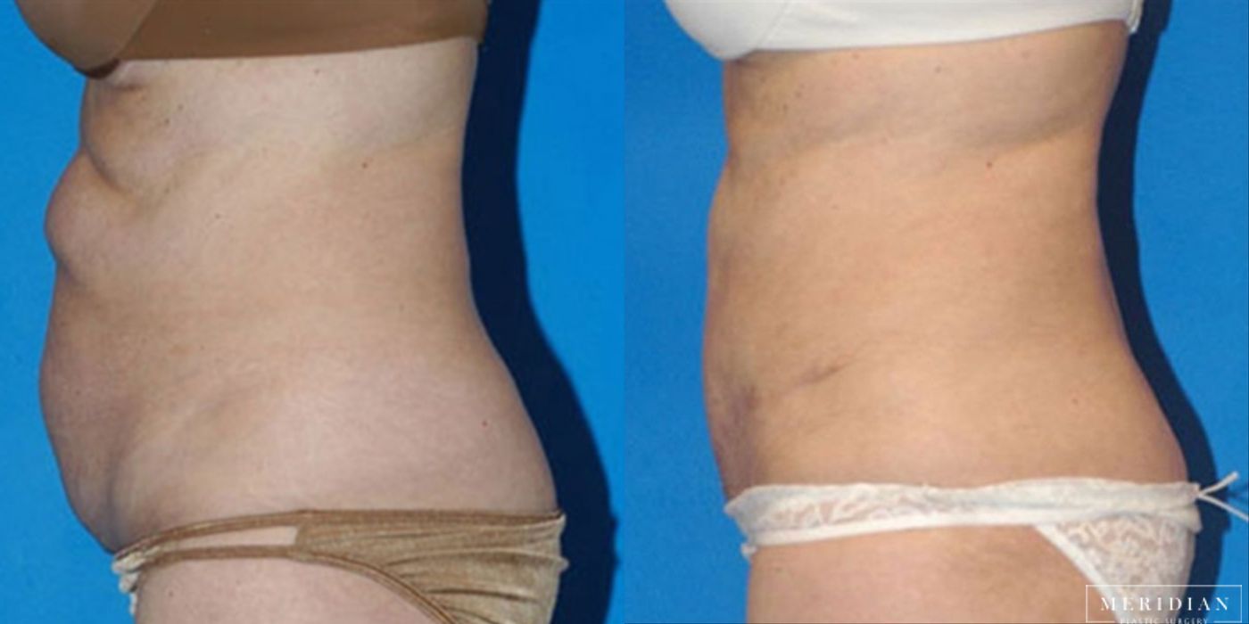 Tummy Tuck - Case 8478