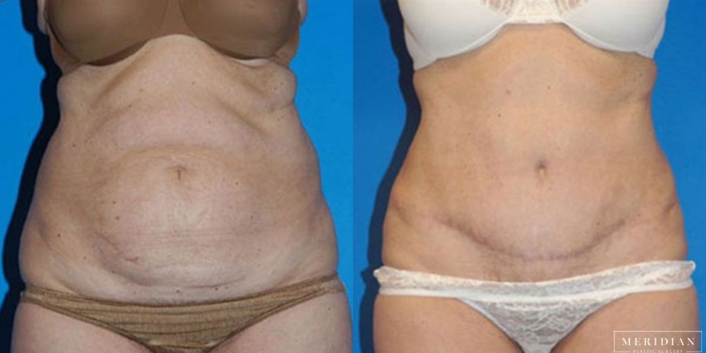 Tummy Tuck - Thumbnail 2